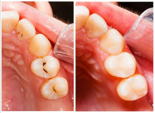 Composite Dental Bonding in Harrisonburg, VA