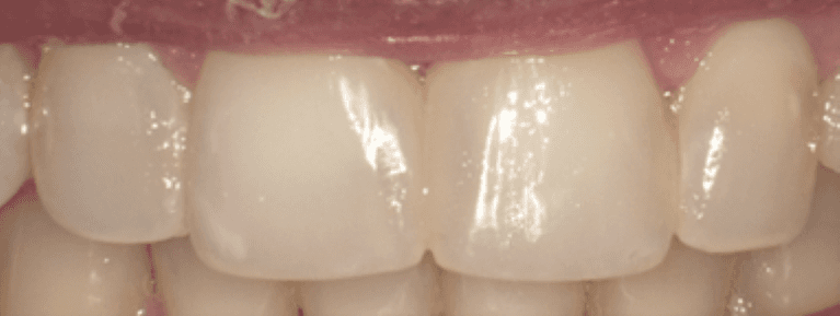Composite-Bonding-to-Reduce-Staining-After-Image