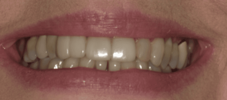 after full smile makeover harrisonburg va