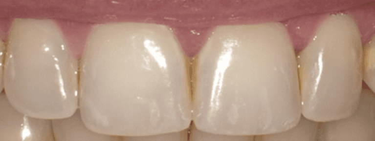 Composite-Bonding-to-Reduce-Staining-Before-Image