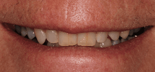 harrisonburg crowns- before